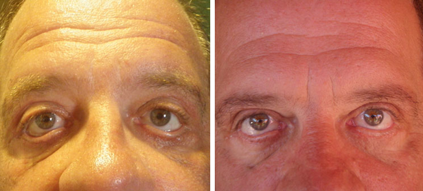 Eyelid Lift Blepharoplasty Before and After
