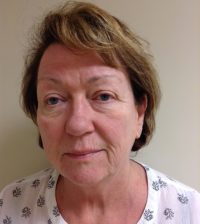 Eyelid Lift