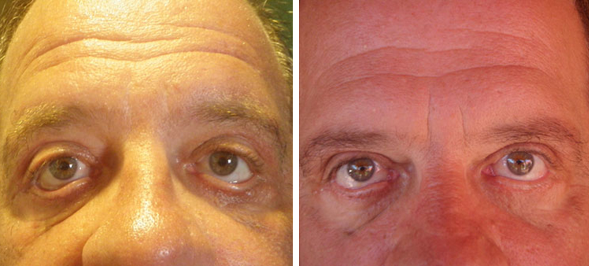 Eyelid Lift Blepharoplasty Before and After