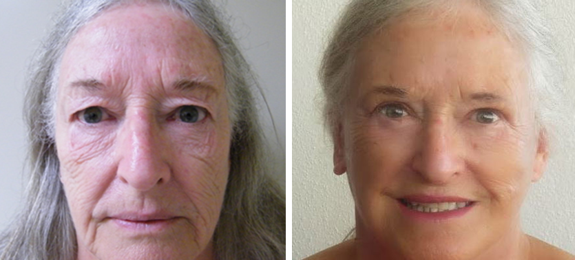 Before & After results of a Facelift by Dr. Nashielli Guadalajara Mexico
