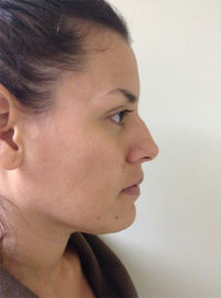 Rhinoplasty