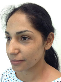 Rhinoplasty