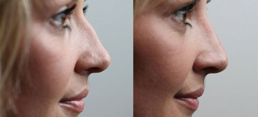 Rhinoplasty Results Guadalajara Mexico