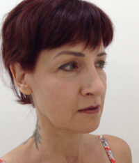 Facelift