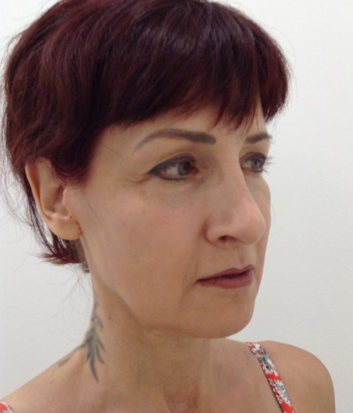 Facelift