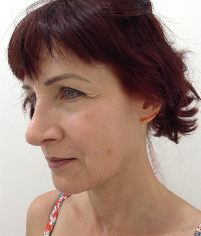 Facelift