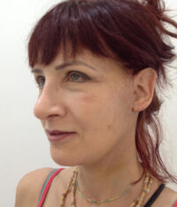 Facelift