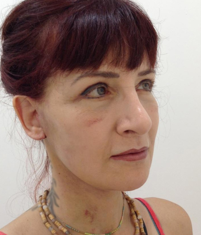 Facelift