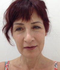 Facelift