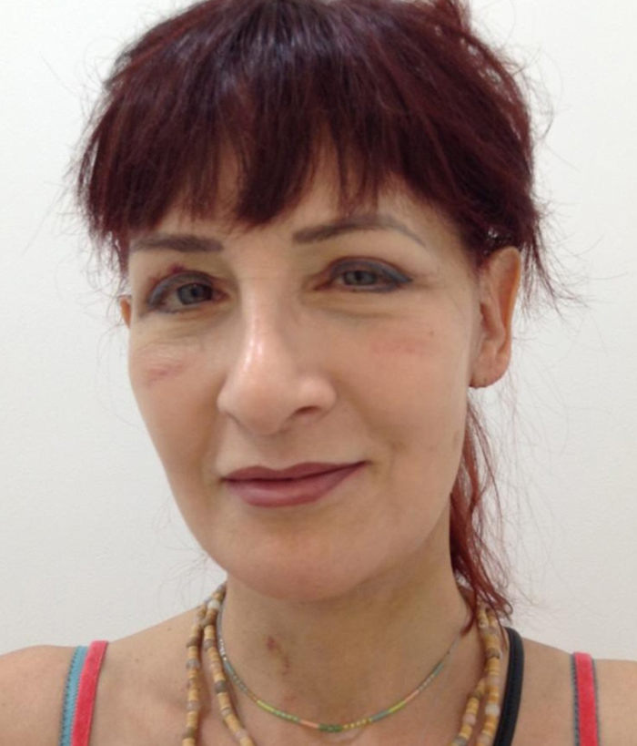 Facelift