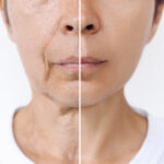facelift before after